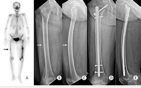 Previous Preoperative Imaging And Six Month Follow Up X Ray Case 1 Download Scientific Diagram