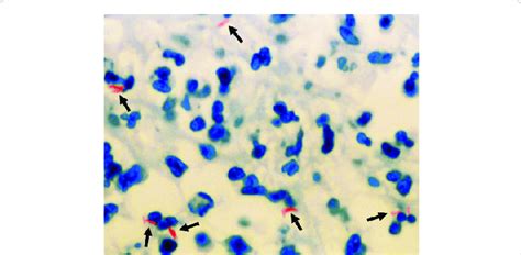 Intestinal biopsy revealing the presence of multiple acid fast bacilli... | Download Scientific ...