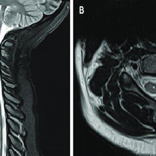 A Postoperative Sagittal MRI Of The Cervical Spine Without Contrast At