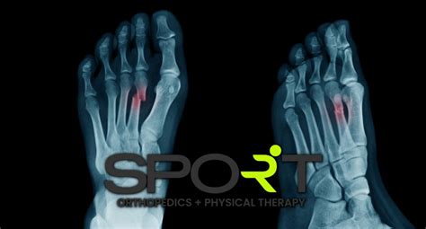 Foot Fracture Treatment | SPORT Orthopedics & Rehabilitation