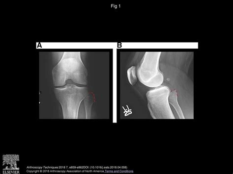 Partial Fibular Head Resection Technique For Snapping Biceps Femoris