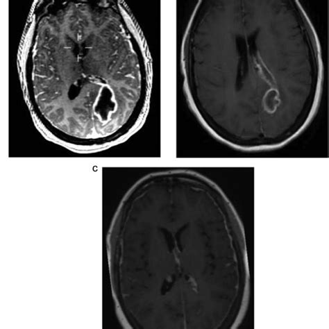 Pathophysiology Of How Brain Abscesses Form In Patients With Congenital Download Scientific