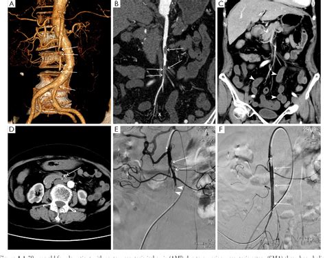 Figure 1 From Relationship Of Superior Mesenteric Artery Thrombus