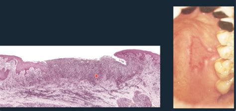 OP - Ulcerative lesions of the oral mucosa Flashcards | Quizlet