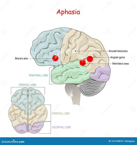 Aphasia Human Brain With Damage To Specific Areas Vector Illustration