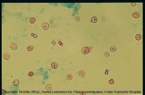 Dysmorphic red blood cells from the urinary sediment of a patient with ...