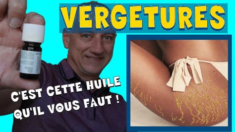 Comment Atténuer Des Vergetures Avec Les Huiles Essentielles Youtube