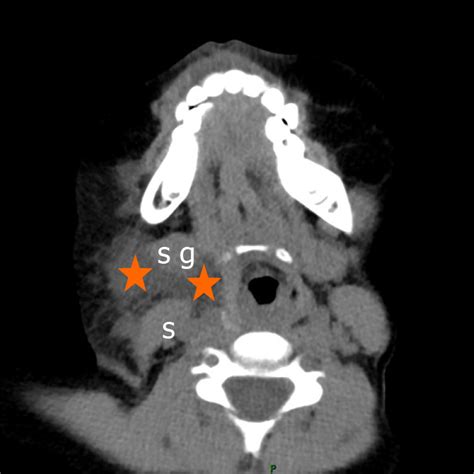 Severe Bleeding After Operation Of Preauricular Fistula A Case Report