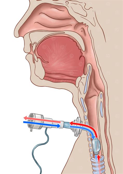 Illustrationen Trachealkan Len Management Medicalgraphics