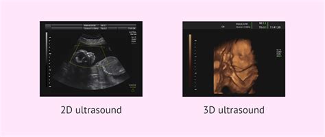 Comparison of 2D and 3D ultrasound