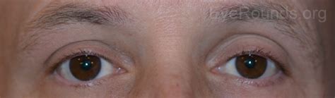 Conjunctival Lymphoma