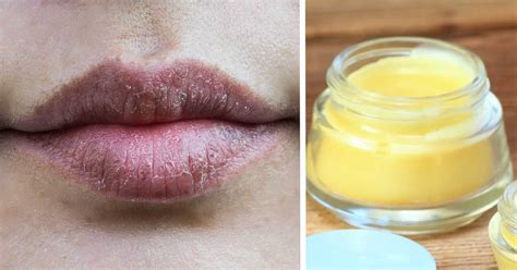 Arriba Imagen Receta Casera Para Labios Resecos Abzlocal Mx