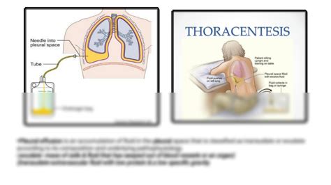 Solution Empyema Pleural Effusion Studypool