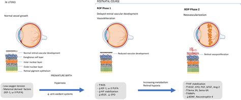 Retinopathy Of Prematurity A Review Of Pathophysiology And Signaling Pathways Survey Of