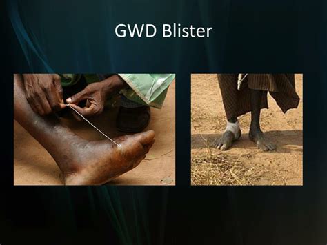 PPT - Guinea Worm Disease PowerPoint Presentation, free download - ID ...