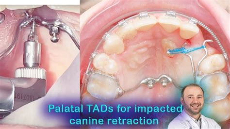 Palatal TADs To Retract Impacted Canine Use Mini Implants Palatelly