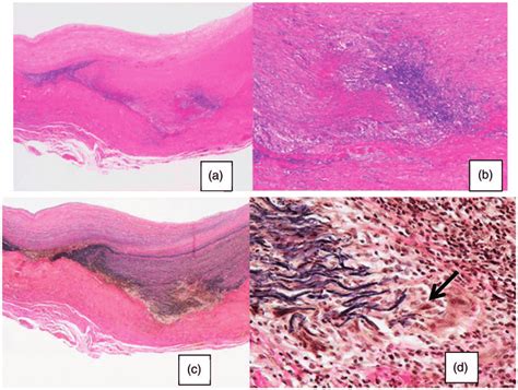 Aortic Biopsy A Hematoxylin Eosin Staining Low Power Field Reveals