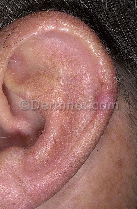 Squamous Cell Carcinoma Ear Photo Skin Disease Pictures