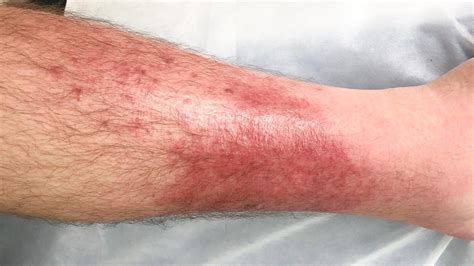 Cellulitis Explained