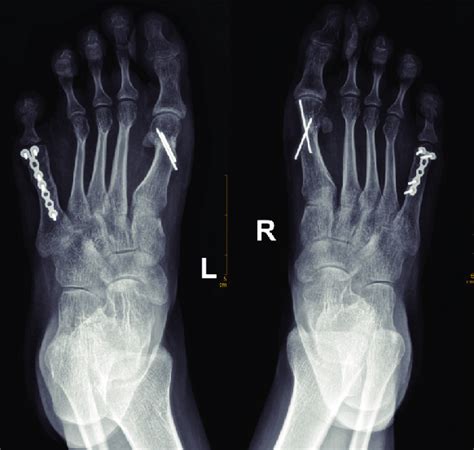 Postoperative Radiograph Of Both Feet At 6 Months After Surgery