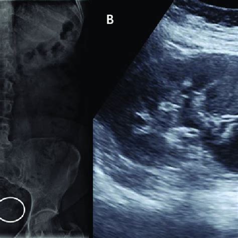 A Abdominal X Ray With Left Pelvic Calcification White Circle B