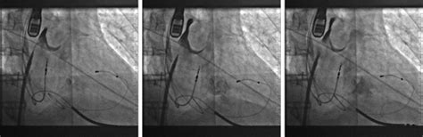 An Unusual Complication Of Transseptal Puncture Jacc Case Reports