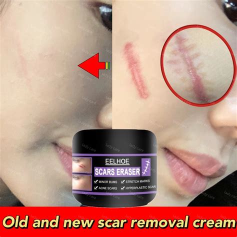 Scar Remover For Old Scar On Leg Fix Scar Strechmark Removal Original