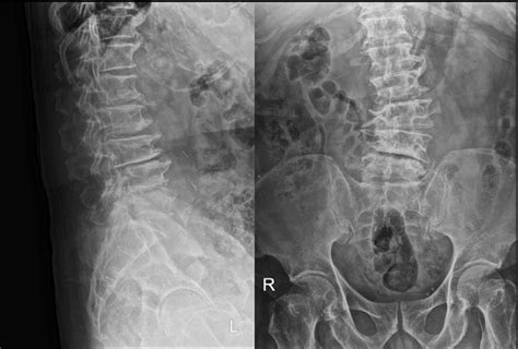 Ap Lumbar Spine Xray