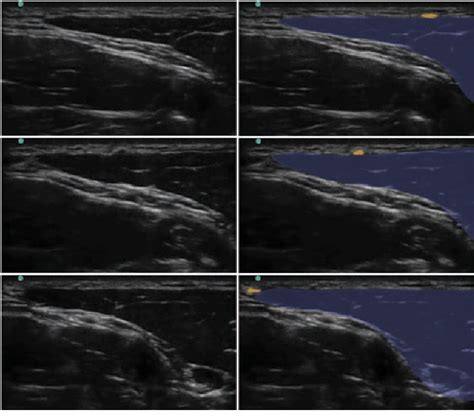 Pdf Ultrasound Guided Greater Auricular Nerve Block As Sole