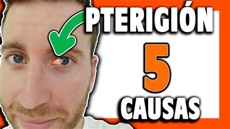 Por qué SALE el PTERIGION o CARNOSIDAD Capítulo 2 YouTube