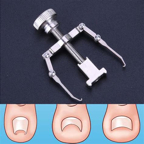 Ingrown Toe Nail Correction Tool Fixer Recover Toe Paronychia Nail ...