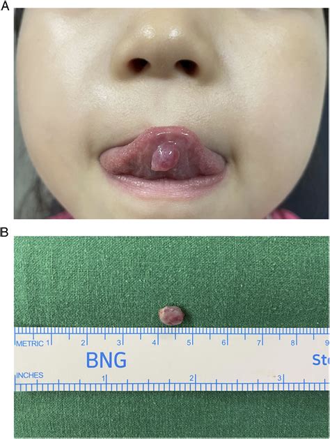 Ventral Surface Midline Cavernous Hemangioma Of Anterior Tongue In A