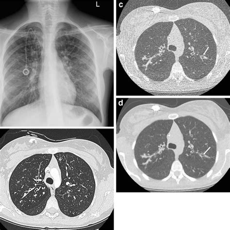 Imaging In A 9 Year Old Girl With Cystic Fibrosis Cf Receiving Download Scientific Diagram