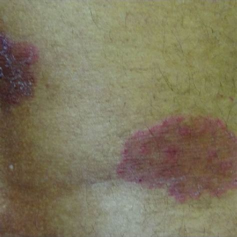 Lesions Of Tinea Corporis On Back Download Scientific Diagram