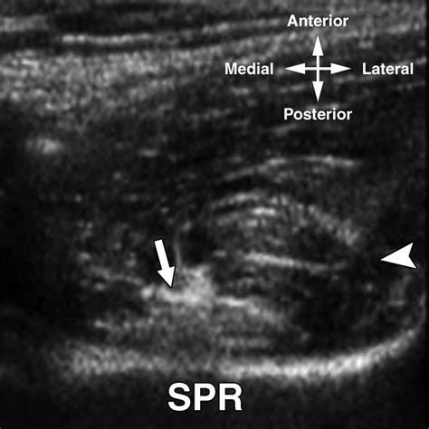 Iliopsoas Tendinopathy Radsource