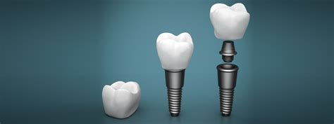 Crowns and Bridges | Bryanston Dentistry - Dr. J Desai