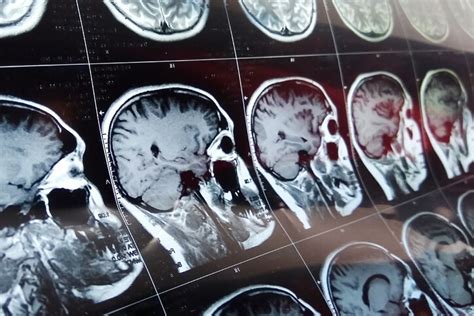 ¿cómo Puede Demostrar Que Ha Sufrido Una Lesión Cerebral Traumática