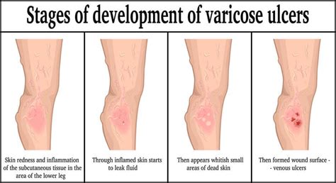 Venous Stasis Ulcer Stages