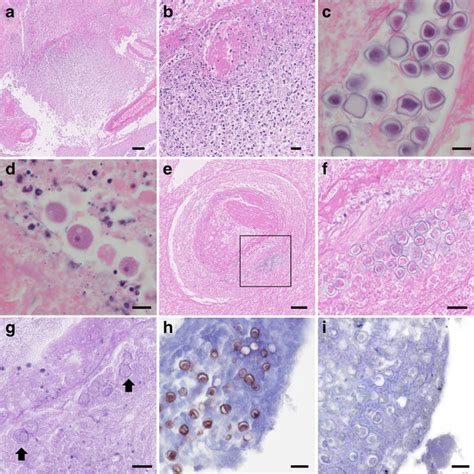 Cytological Findings Of Group 1 Acanthamoeba In Csf A And B Giemsa Download Scientific Diagram