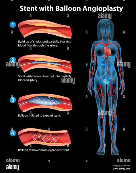 Stent In The Heart