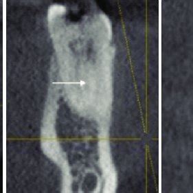 A Cone Beam Computerized Tomography Image Showing Middle Mesial