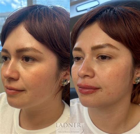 Dermal Fillers Before And After Pictures Case 209 Denver Co Ladner Facial Plastic Surgery