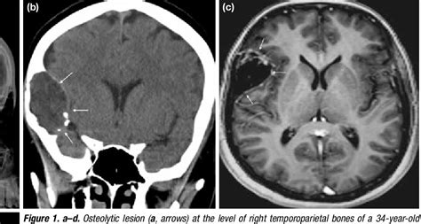 Figure 2 from Radiological Approach to Osteolytic Benign Calvarial ...