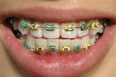 Coloured Braces In Surrey Guildford Orthodontic Centre