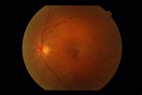 Idiopathic Juxtafoveal Retinal Telangiectasis