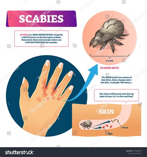 Pictures Of Mild Scabies Rash