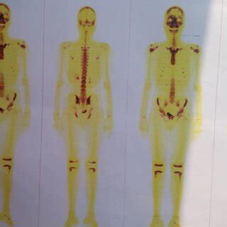 Bone Scintigraphy of the patient. | Download Scientific Diagram