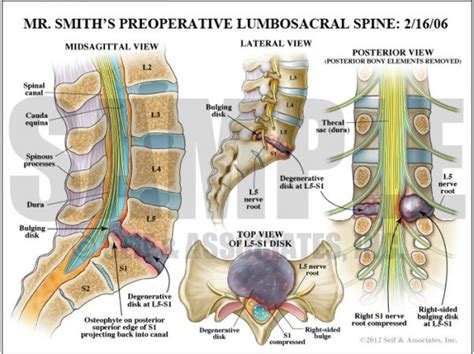 Lumbar Nerve Roots Anatomy