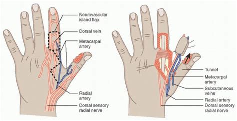 Fingertip Amputations Musculoskeletal Key