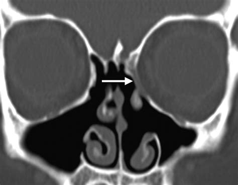 Failed Endoscopic Sinus Surgery Spectrum Of Ct Findings In The Frontal